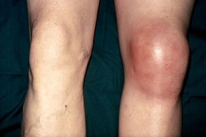 healthy and swollen knee in pain
