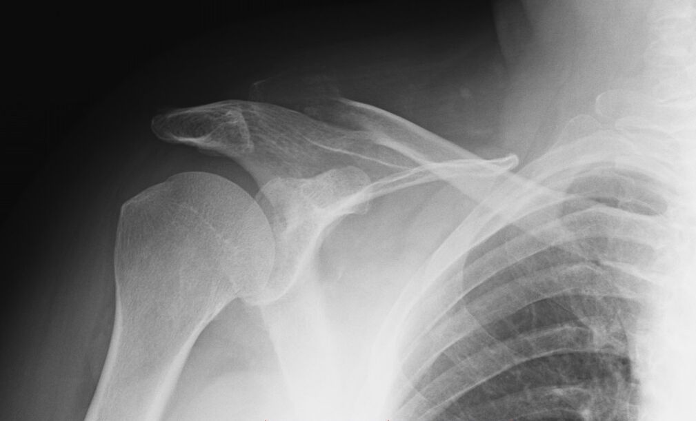 x-ray shoulder arthrosis