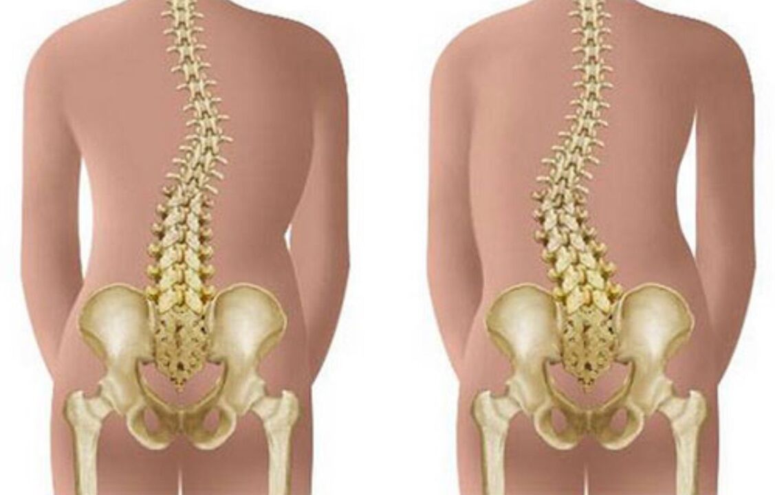 scoliosis as a cause of back pain in the shoulder area