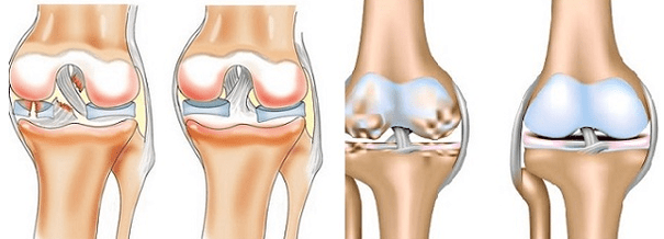 Arthritis and arthritis