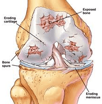 Mechanism of arthrosis development